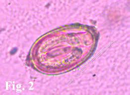 Capillariasis | Spain| PDF | PPT| Case Reports | Symptoms | Treatment