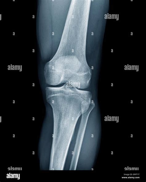 Normal Knee X Ray Lateral View