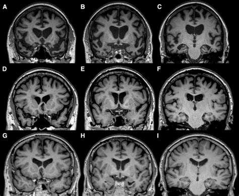 Corticobasal Degeneration - Symptoms & Causes