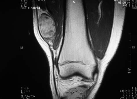 2C MRI Axial Synovial Sarcoma. Synovial sarcoma is a common soft tissue malignancy accounting ...