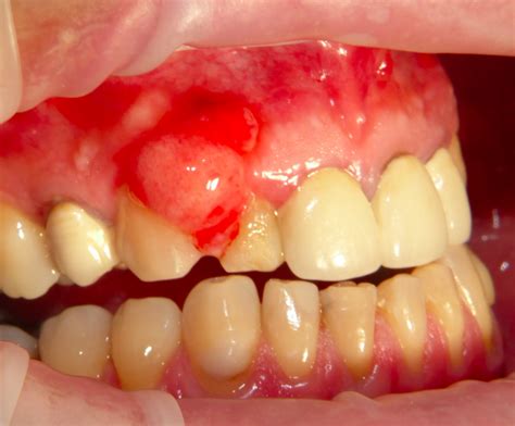 Gingival swelling adjacent to the dental elements roots; a clinical case | Dentistry33