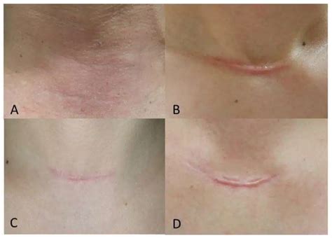 When Should Scar Removal Treatments Start? - 1Aesthetics, Medical & Surgery