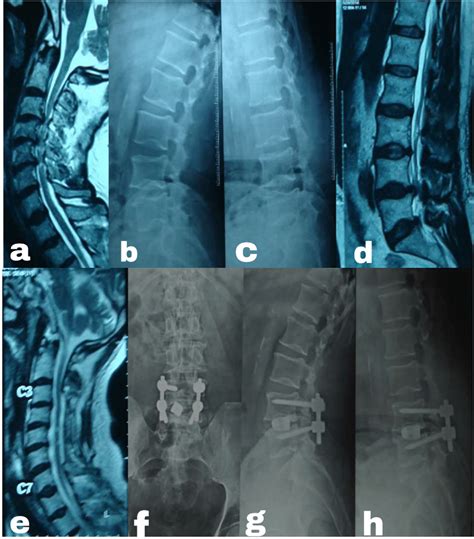 a) MRI T2 sagittal cervical spine showing multilevel stenosis with... | Download Scientific Diagram