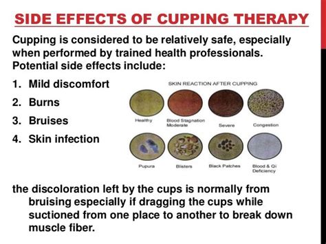 Cupping therapy