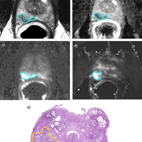 A 62-year-old man with Gleason Score 3 + 4 prostate cancer. The ...