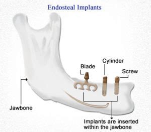 Types of Dental Implants: Endosteal, Transosteal & Subperiosteal | Dr ...