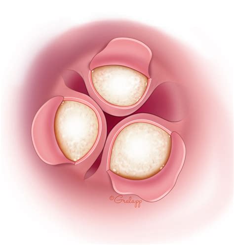 Exostoses of the Ear Canal – Oto Surgery Atlas