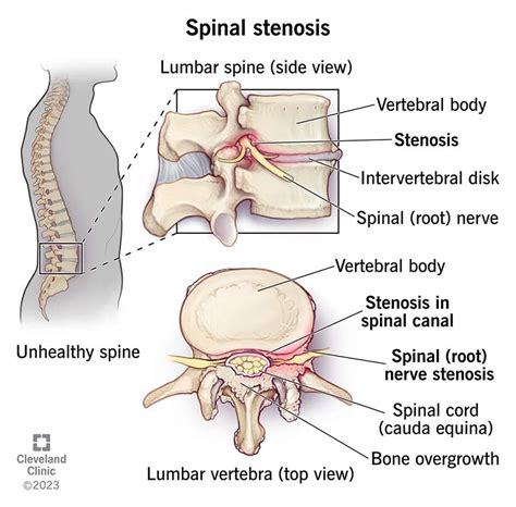 Spinal stenosis - Medagg