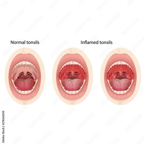 Normal Throat And Tonsils