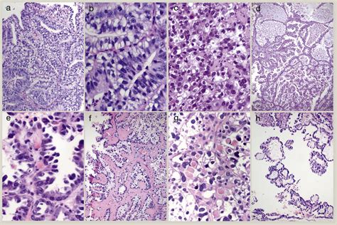 Clear cell-rich cancers: Endometrioid carcinoma with clear cytoplasm ...