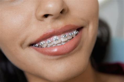 A Parent's Handy Guide to the Different Types of Kids Braces | Pediatric Dentistry & Orthodontics