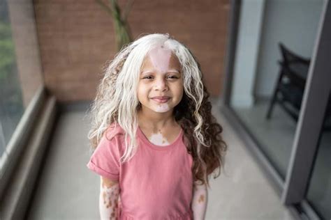 Vitiligo in Children: Causes, Symptoms, Types & Treatment