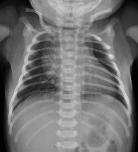 Birth fracture - clavicle fracture: The lungs and pleural spaces are clear, but there is a left ...