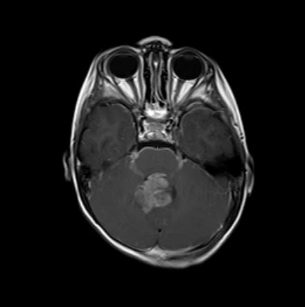 Medulloblastoma Icd 10