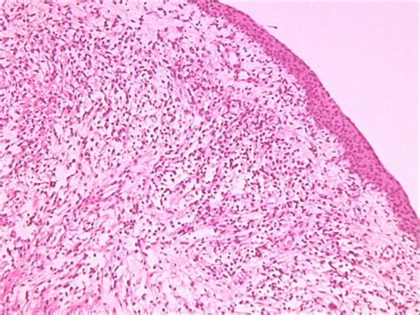 sarcoma botryoides pathology