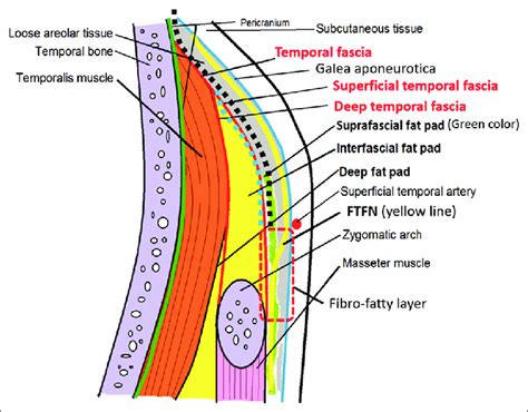 Schematic depiction of the anatomy of the temporal area in the coronal... | Download Scientific ...