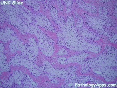 myositis ossificans pathology