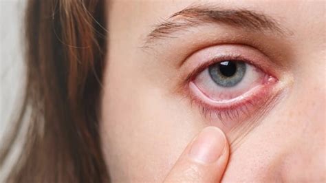 Eye eczema: What is eyelid dermatitis, know all about triggers, warning ...