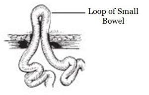 Ileostomy - Maher A. Abbas, MD