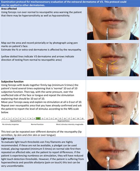 Mechanosensory tests for routine assessment of surgical trigeminal ...