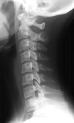 Imaging of the Cervical Spine