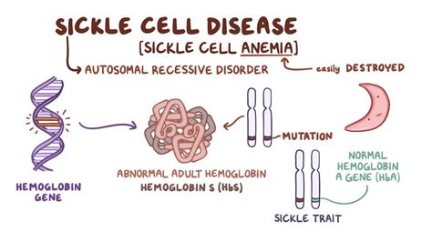 Sickle cell disease: Clinical practice - Osmosis