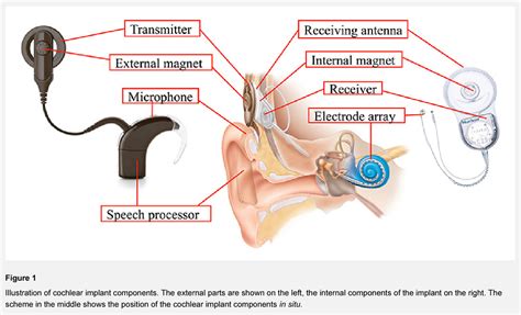 Cochlear Implant Diagram