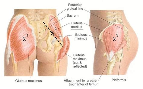 Gluteal Tendinopathy in Melbourne