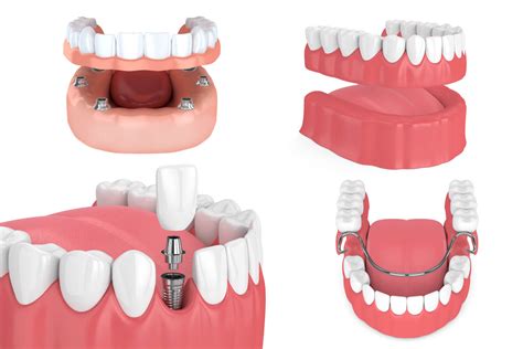 Dentures vs. Dental Implants | Dental Health Associates | Wolcott, CT