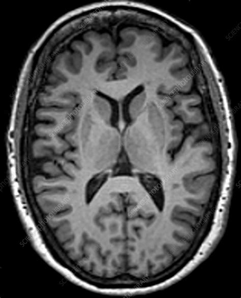 Normal Brain Mri