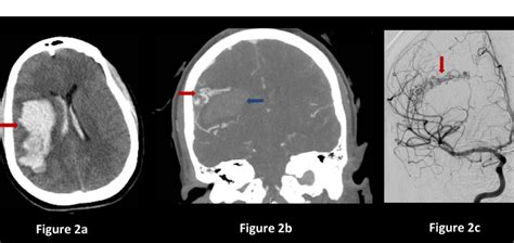 Brain Arteriovenous Malformations (AVMs) | Baylor Medicine