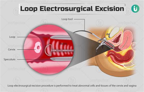 Loop electrosurgical excision procedure (LEEP): Procedure, Purpose ...