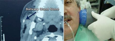 Salivary Gland Stones Treatment: Lithotripsy