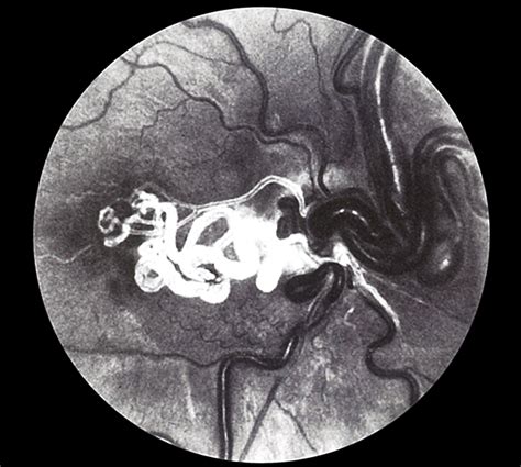 Racemose Hemangioma - Retina Image Bank