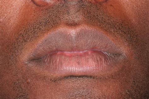 Common Lip Abnormalities | Smiles for Life Oral Health