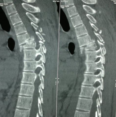 Fracture dislocation vertebra | Spinal cord injury, Spinal cord, Spinal