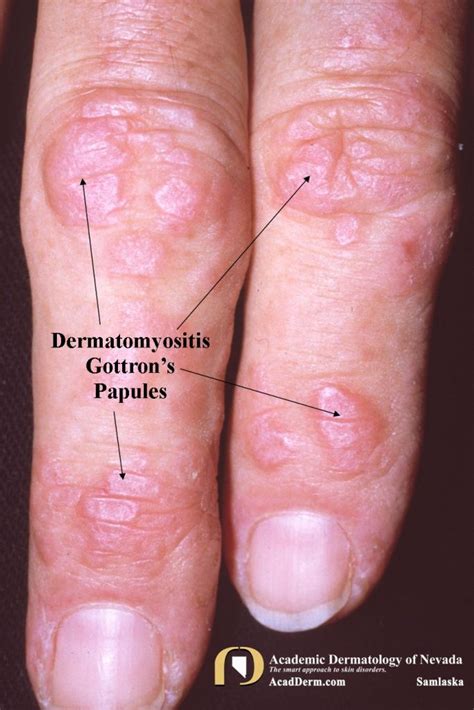 Dermatomyositis - Academic Dermatology of Nevada