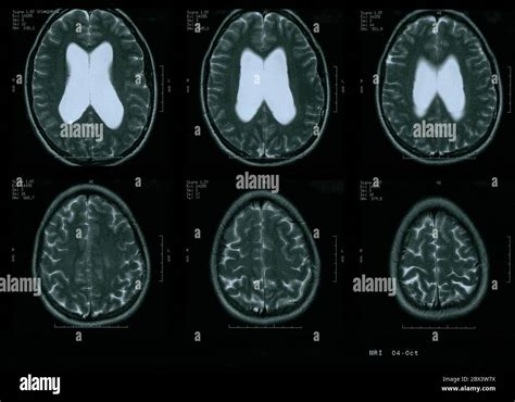 Severe Hydrocephalus Mri