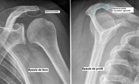Acromion Types