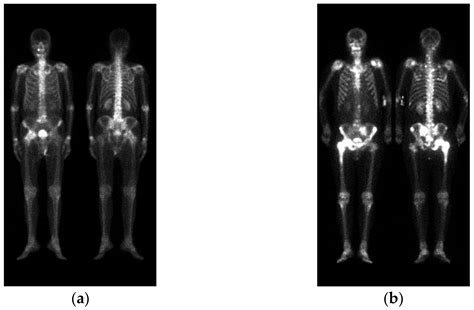 Electronics | Free Full-Text | Bone Metastasis Detection in the Chest ...