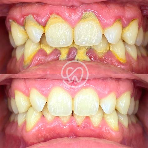 Limpieza dental profunda: antes y después