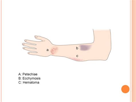 Ecchymosis Vs Hematoma