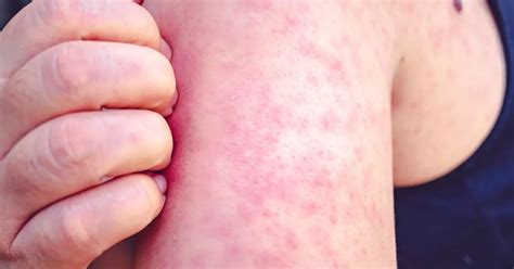 'German measles' symptoms include horror rash - but with a noticeable difference - Mirror Online