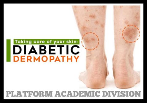 ”Diabetic shin spots/ Diabetic Dermopathy” – Platform | CME