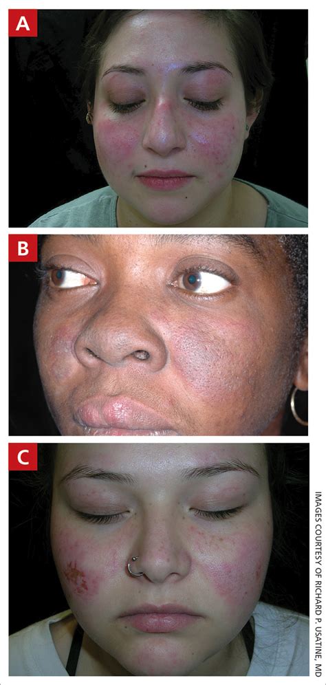 Systemic lupus erythematosus | MDedge Family Medicine