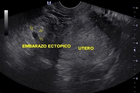 Ultrasonido endovaginal como método diagnóstico oportuno del embarazo ectópico no roto