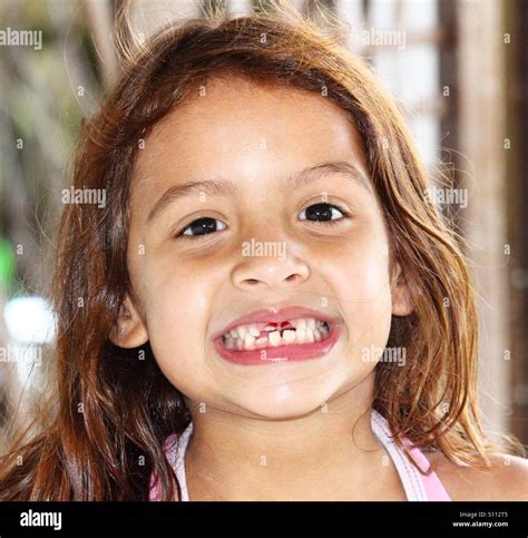 Little girl who is missing her 2 front teeth Stock Photo, Royalty Free Image: 310425477 - Alamy