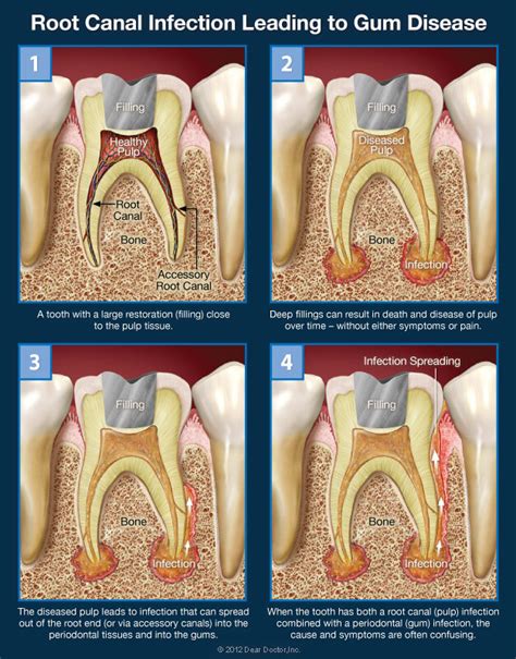 Is it a Root Canal Infection, Gum Problems, or Both?