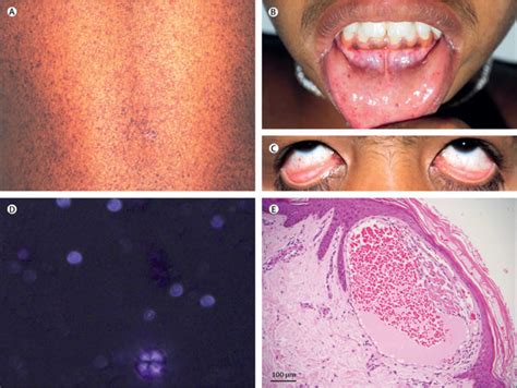 Fabry disease causes, symptoms, life expectancy, diagnosis and treatment