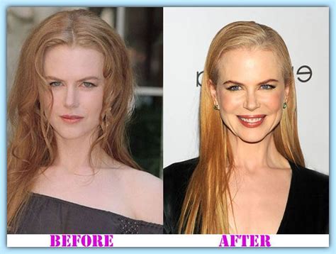 Nicole Kidman Plastic Surgery did not evole as she anticipated